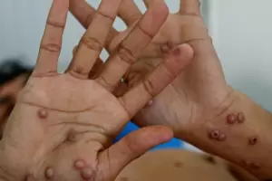 Lo que nos faltaba: confirma en Argentina el primer caso de la cepa m�s agresiva de la "viruela del mono"