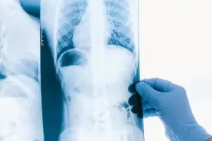 D�a Mundial de la Tuberculosis: 34 pacientes en tratamiento en Catamarca