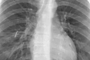 En el San Juan Bautista extrajeron una aguja del pulm�n de un joven de 16 a�os