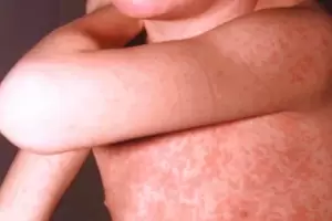 Alerta por la expansi�n de una enfermedad altamente contagiosa durante el Mundial