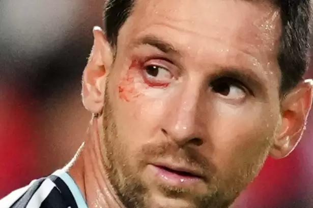 Qu� le pas� a Messi en el ojo: el 10 recibi� atenci�n en medio del partido